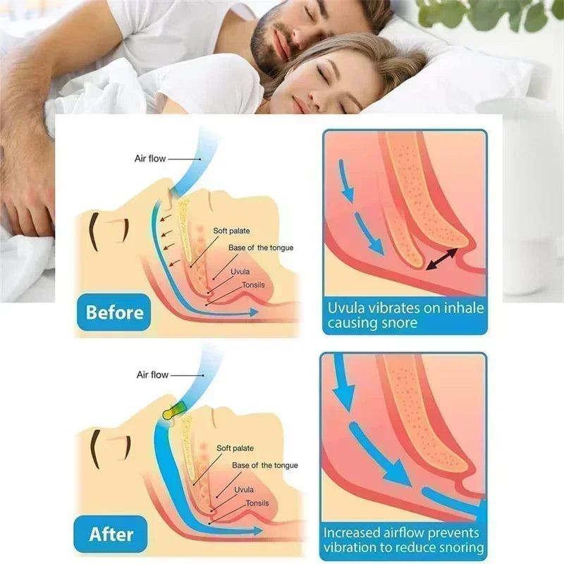 Anti-Snoring Aide, silence snoring.